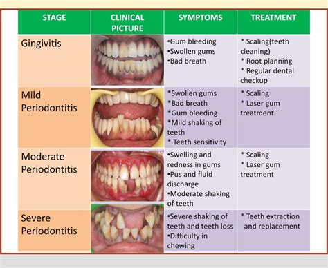 Gingivitis Treatment .